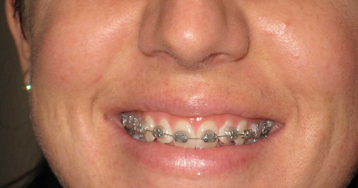 A Bride With Braces and a Bump My Teeth Hurt