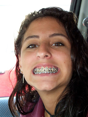 braces smile