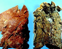 Normal Lung and Bad Lung