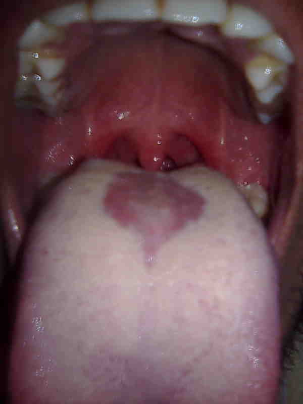 Rhomboid Tongue