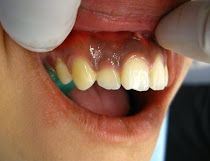 Crown lengthening