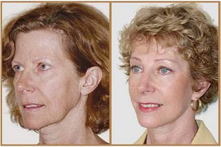 cosmetic surgery before and after photo