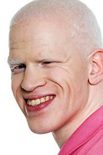 Albino Black Boy