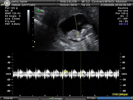 Baby's heartbeat