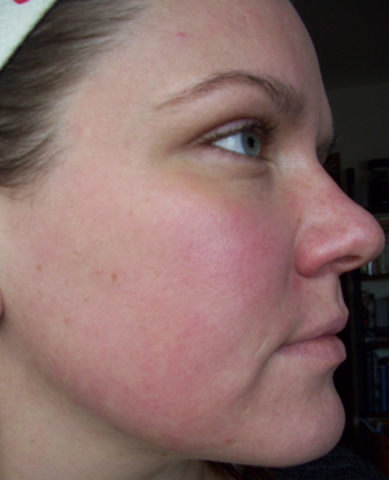 [Post+Pearl+After+Results+Cheek.JPG]