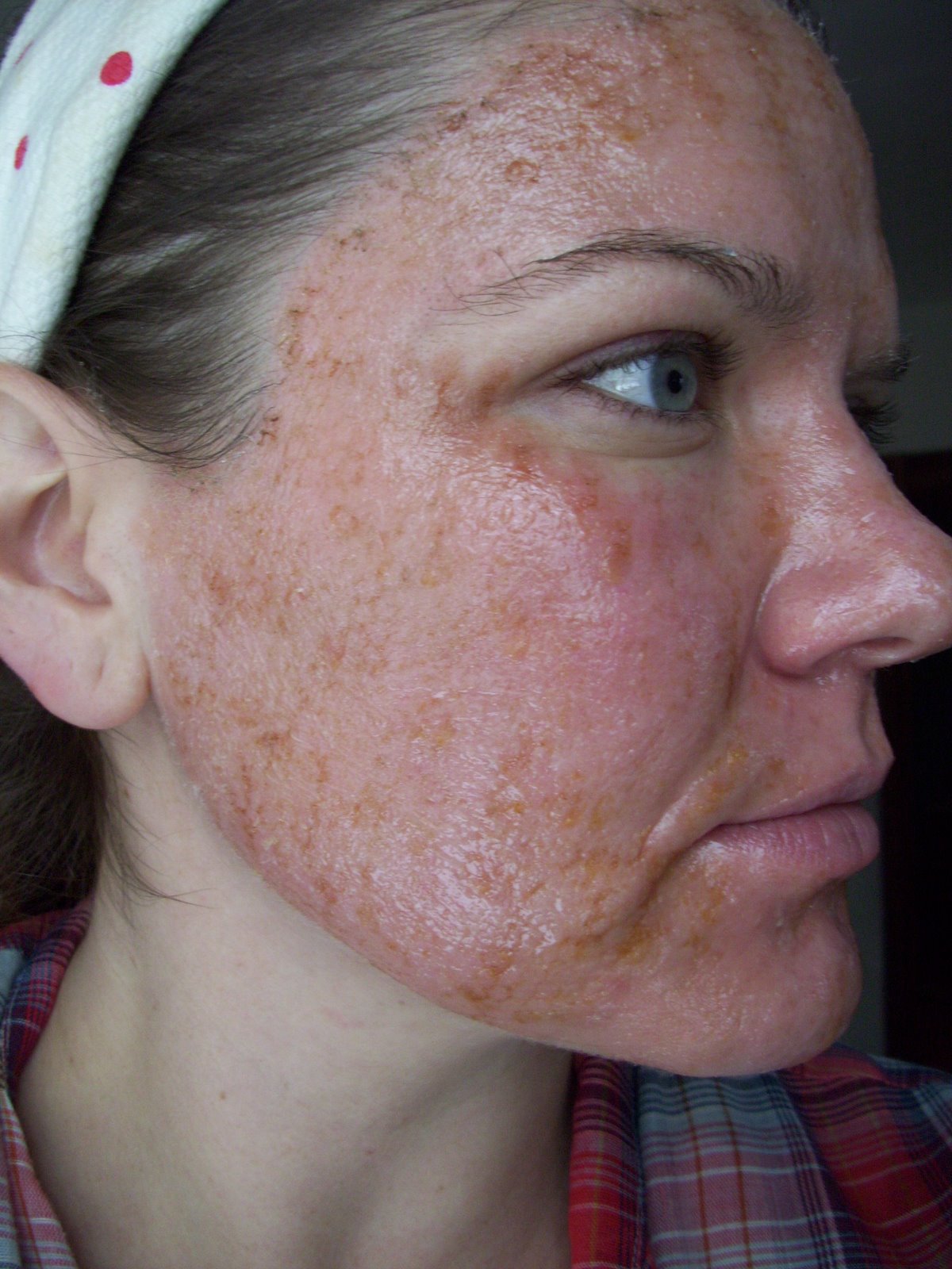 [Post+Pearl+Yellowish+Flim+Forming+Cheek.JPG]