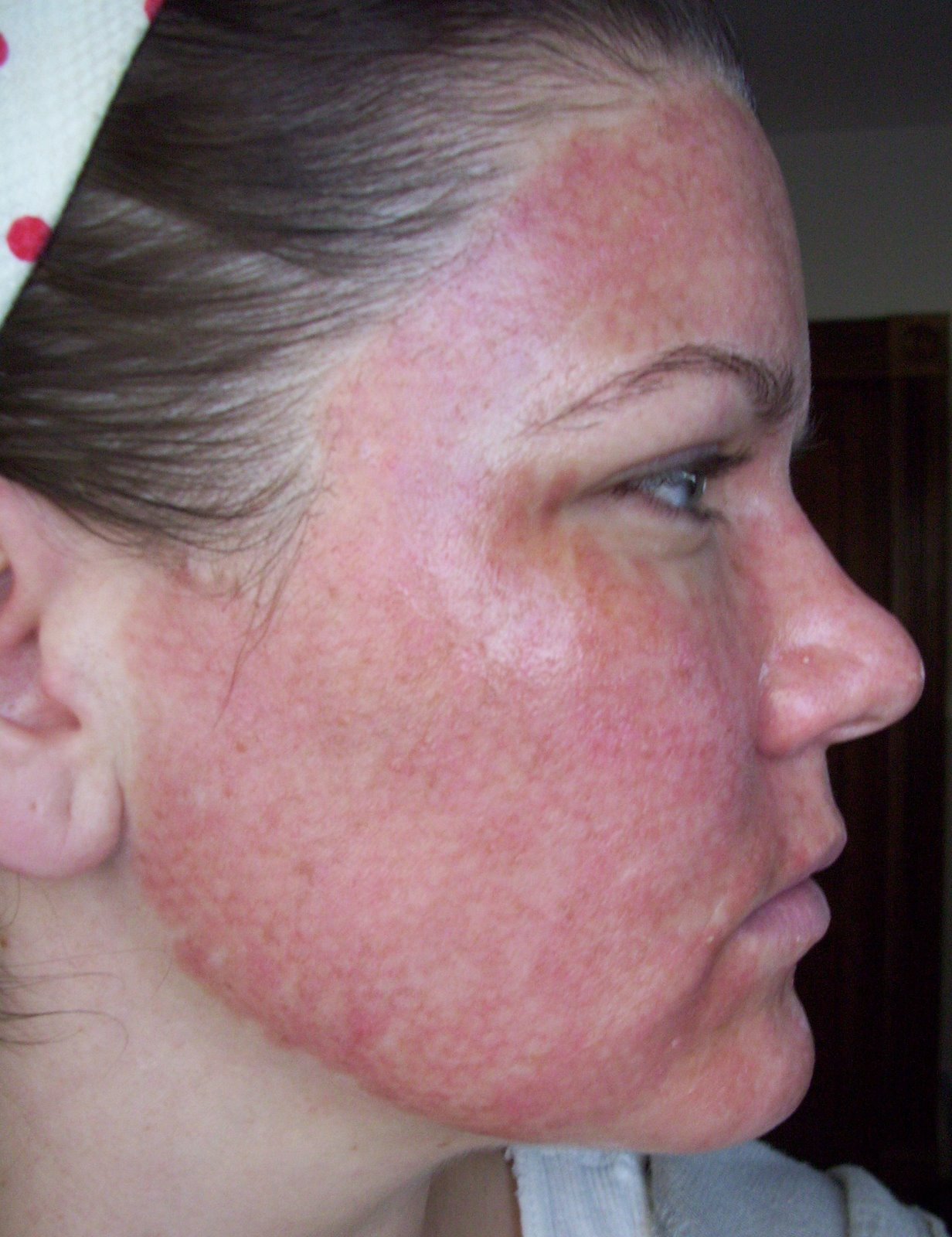 [Post+Pearl+Day+2+Red+Beginning+Cheek.JPG]