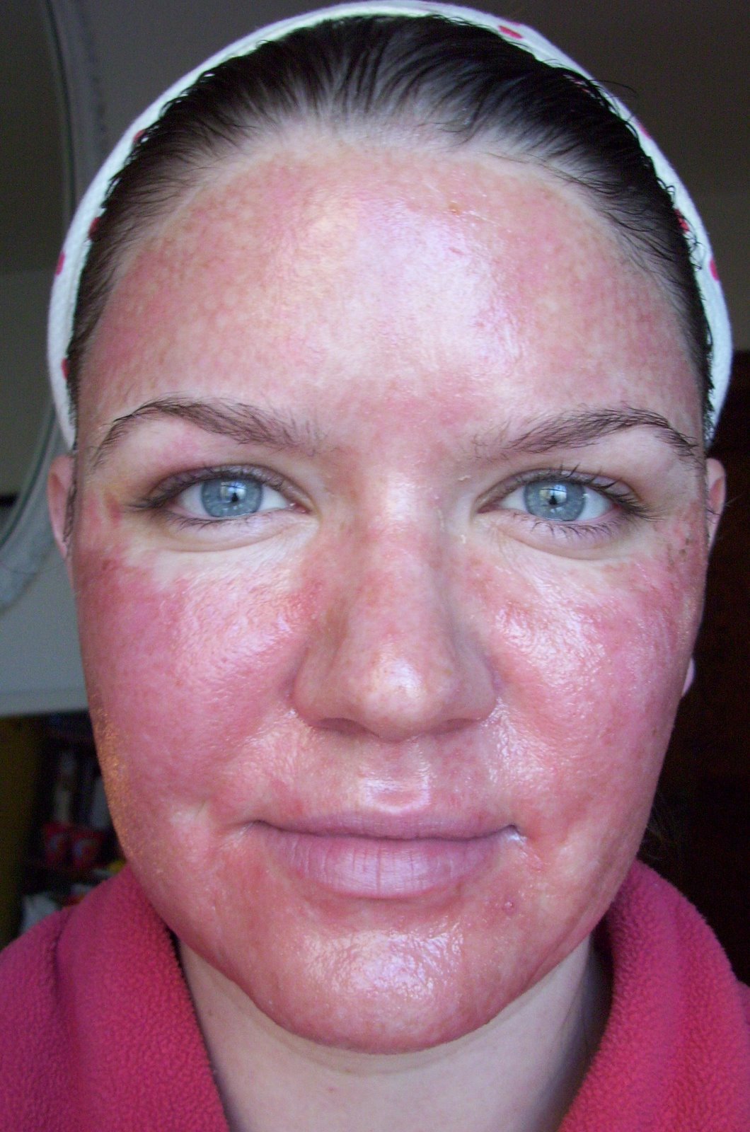 [Post+Pearl+Day+3+Red+Swelling+Full+Face.JPG]