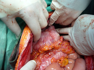 Trocar Chest Tube