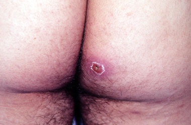 Mrsa Stages