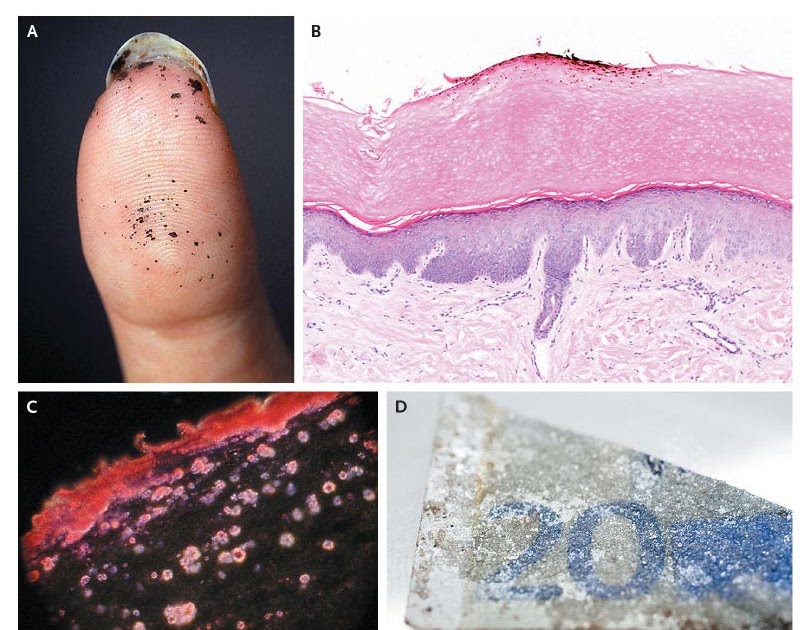 Skin Discoloration... NEJS
