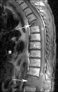 Kathy's MRI Pathology Blog: Metastatic epidural spinal cord compression
