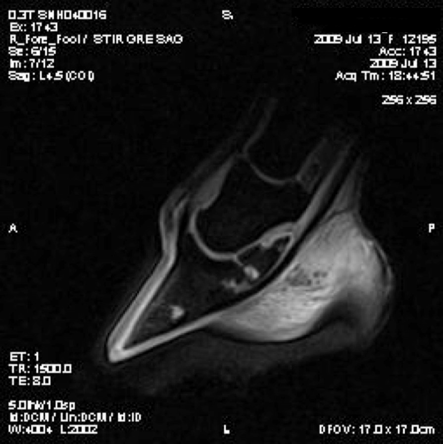 Navicular Bone Fracture Thomas's case study is a sponsored blog post in cooperation with -3.bp.blogspot.com