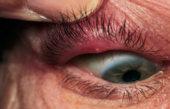 Clínica de olhos Levate - 👀 Terçol ou Hordéolo: 1. O que é? Pequeno nódulo  infeccioso na região palpebral, mais precisamente na base dos cílios.  Geralmente ocorre por uma obstrução das glândulas