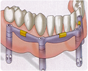 人工牙根的義齒—活動式