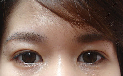 syringoma under eyes