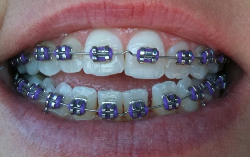 Braces at 37 First Adjustment! Ouch!