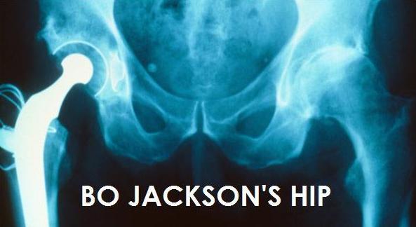 BO JACKSON'S HIP