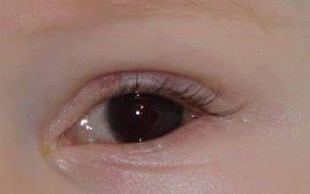 10 days, showing hyphema