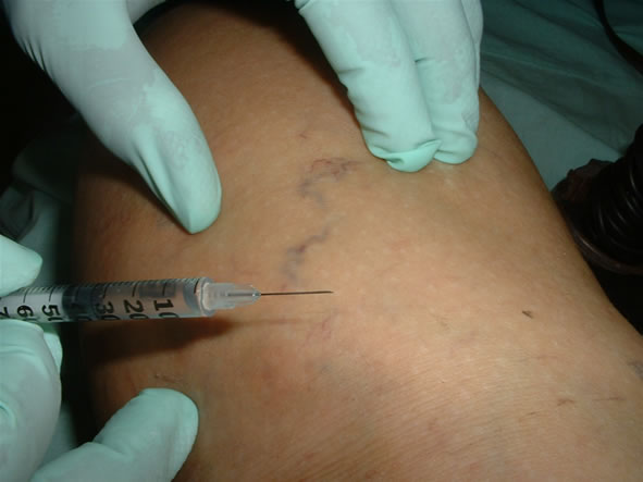 [tratamiento+varices.jpg]