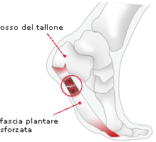 LUCKY_73di corsa!: Scacco alla fascite plantare in 4 mosse