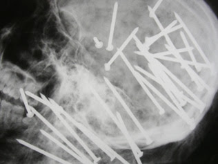 X-ray shows Chen Liu's nail gun death