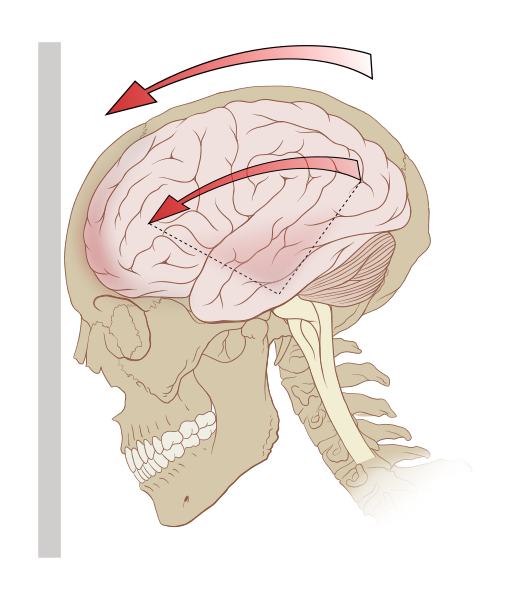 [comcussion+skelteton]