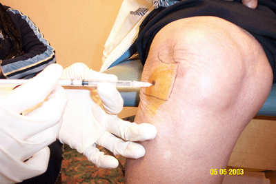 Steroid shot for knee arthritis