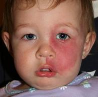 Sturge weber v1 picture