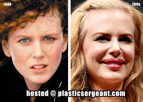 Nicole Kidman admits (again) she had BOTOX on Marie Claire 2011 Nicole Kidman admits (again) she had BOTOX on Marie Claire 2011