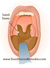Bad breath-Tonsil-stones