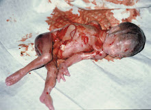 Aborted 22 weeks