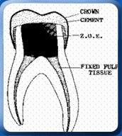 [completedpulpotomy.jpg]