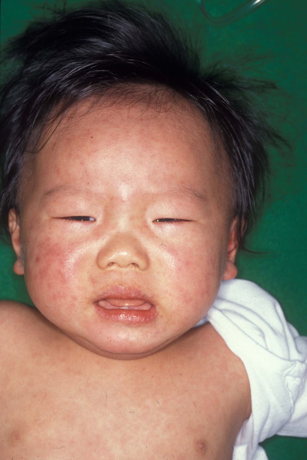 Measles Vaccine Rash