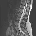 Normal Spinal Mri