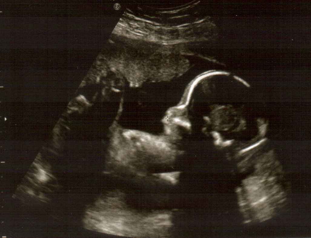 [ecografia+21s.BMP]
