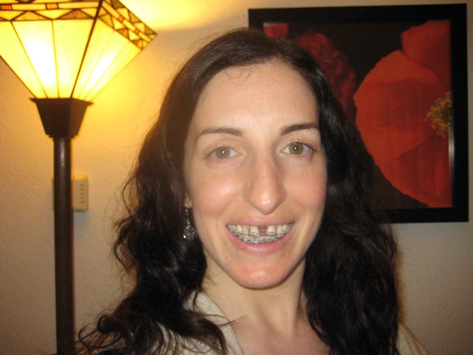 SARPE, Jaw Surgery and Adult Braces, Oh My! Tin grin!