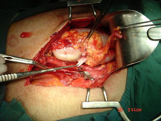 http://3.bp.blogspot.com/_wpOYs20lSWk/SsnYqRUCUqI/AAAAAAAAADo/IxQHy-Fwiv4/s320/up+side+down+kidney+transplant+001.jpg