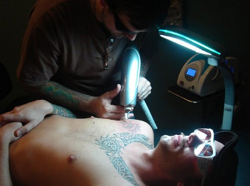  then you have to go for laser tattoo removal procedure.