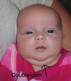 chin cleft