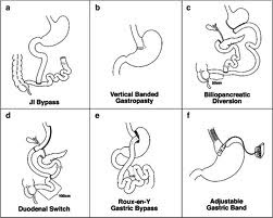 Bariatric Bypass Surgery