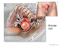 Herbal Ingredient to Overcome Ovary Cyst