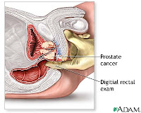 Herbal Remedy Cure Prostate Disorders