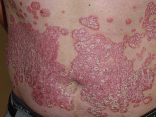 [psoriasis.jpg]