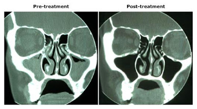 Sinusitis Ct