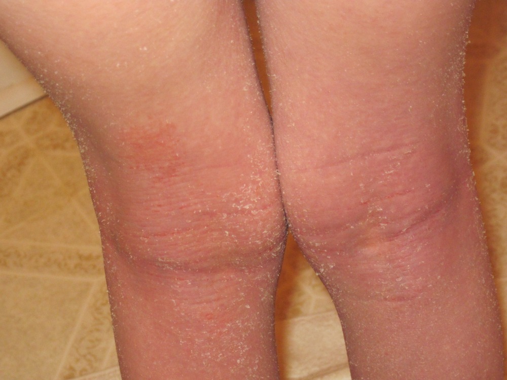 Behind knee itch - RightDiagnosis.com.