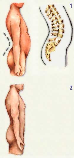 Hiperlordosis Lumbar