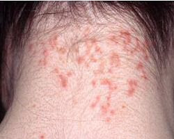 lice on skin