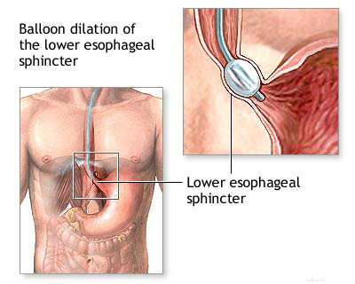 Valuable opinion Hernias on the outside of anal of a male Hernias on the outside of anal of a male