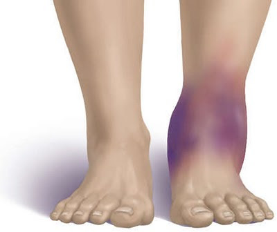 Contusion Treatment